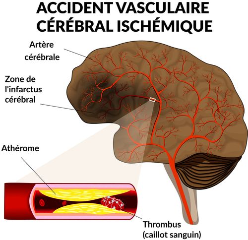 Les Accidents Vasculaires Cérébraux Ischémiques - Symptômes Et ...