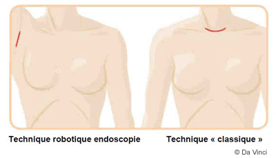 Schéma chirurgie thyroïde
